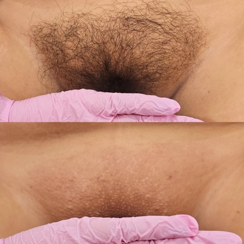 Brazilian wax before and after by Austhetics