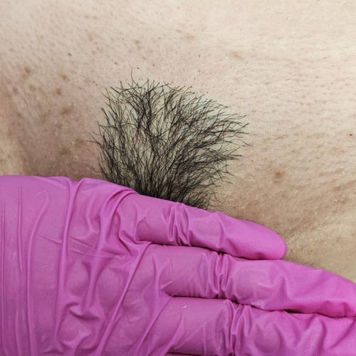 Brazilian wax — triangle by Austhetics