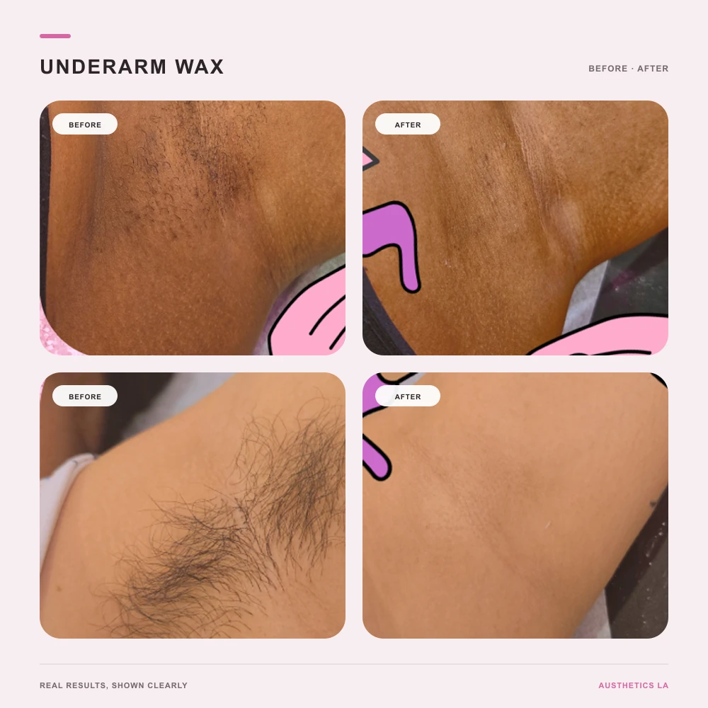 Austhetics underarm waxing before-and-after results