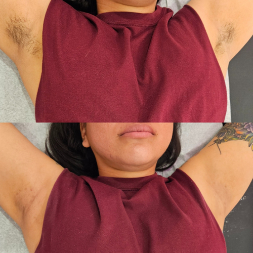 Underarm wax before and after by Austhetics